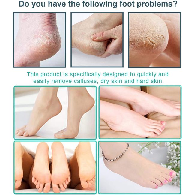 Foot File Callus Cracked Heels Hard Dead Skin Remover Feet Filer Care Tool