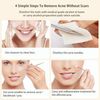 BESTOPE Blackhead & Acne Remover Pimple Comedone Extractor Tool (Ship From USA)