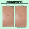 Peace Out Dark Spots Microstructure Dots for Hyperpigmentation 2 Count Pack