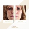 Kedma - Aloe Vera Gel Soothing and Moisturising - Relieves Irritation and Sunburn - For All Skin Types - 100ml