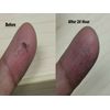 contact dermatitis cream non-steroids