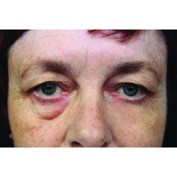 RX Flawless Eyes - 1 x 10ml Bottle. 100 Applications