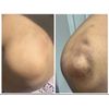 Dark Pigment Inner Thigh  Under Arm In Thigh Elbow