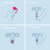 Intimina Lily Cup Compact - Small Menstrual Cup with Flat-fold Compact Design, Disposable Menstrual Cups, Period Cup Reusable (Size B)