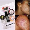 Retinol Face Exfoliant Cleanser/Toner Acne,Spots Hyperpigmentation & Sunburn 2oz