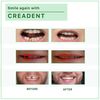 CREADENT Kit for replacing a missing tooth with a temporary cosmetic tooth