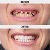 Denture Repair Kit, Soft Dentures False Teeth, DIY Resin Denture Kit for Repair Missing Teeth