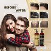 DHT Pro Shampoo and Conditioner Advanced Formula with Procapil and Capixyl, D...