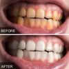 Harmony Life 28pc Teeth Whitening Strips 6% Hydrogen Peroxide Bleaching Strips