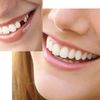 INSTANT SMILE SELECT A TOOTH REPLACEMENT KIT temporary missing tooth fix BRIGHT