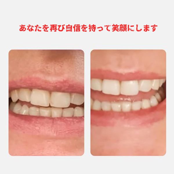 Self-made simple dentures | Dentures, front teeth of dentures | Apply to top and bottom | Make a smile instantly | Resin whitening dentures | Oral health | Partial dentures | Dental materials | Dental