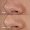 Clinique BLACKHEADS SOLUTIONS SELF-HEATING BLACKHEAD EXTRACTOR