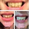 Smile Titan Teeth Whitening Kit with LED Light, 3 Carbamide Peroxide Teeth Whitening Gel Express Teeth Whitener. Remove Stains from Coffee, Smoking, Wine, Food (5 Piece Set)
