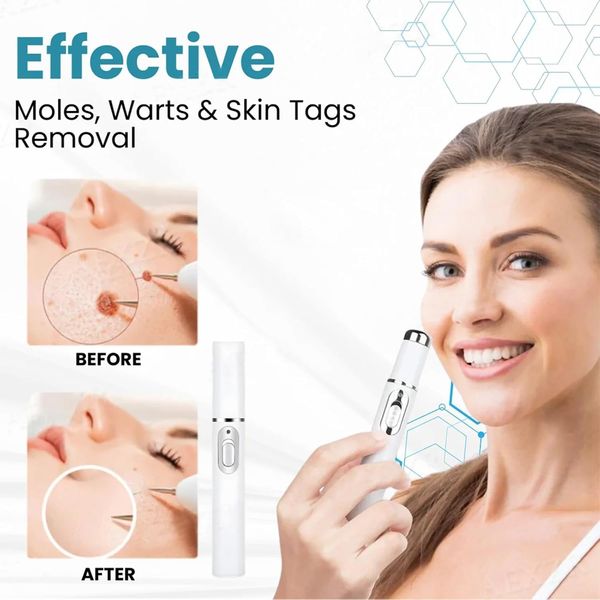 Non-Invasive Mole and Wart Removal Pen, Laser Skin Tag Removal Pen, Professional Dark Spot Remover for Face and Body, Suitable for All Skin Types