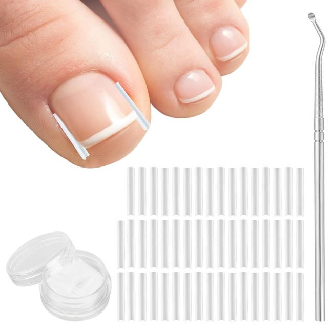 (50+1) Pcs Ingrown Toenail Corrector Treatment Set, Professional Pain-Free Ingrown Toenail Removal Kit with Toenail Lifter, Easy Fixed Ingrown Toenail Tool, Toenail Straightener Strip for Men Women