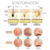 9 piece Blackhead Cleaner / Remover Acne/Comedone Extractor Tool Easy extraction