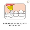 TePe INTERSPACE SOFT 12-piece replacement tip set for orthodontics and implants