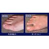 Aimedia Bunion Fit Pad, Pack of 2, Bunion Supporter, Bunion Goods, Toe Supporter, Toe Supporter, Toe Pad, Protective Pad, clear