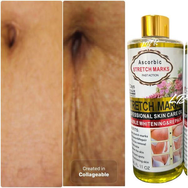 Ascorbic stretch-mark Oil,Body Oil For Scars & Stretch marks,oil Hydrates,Fades