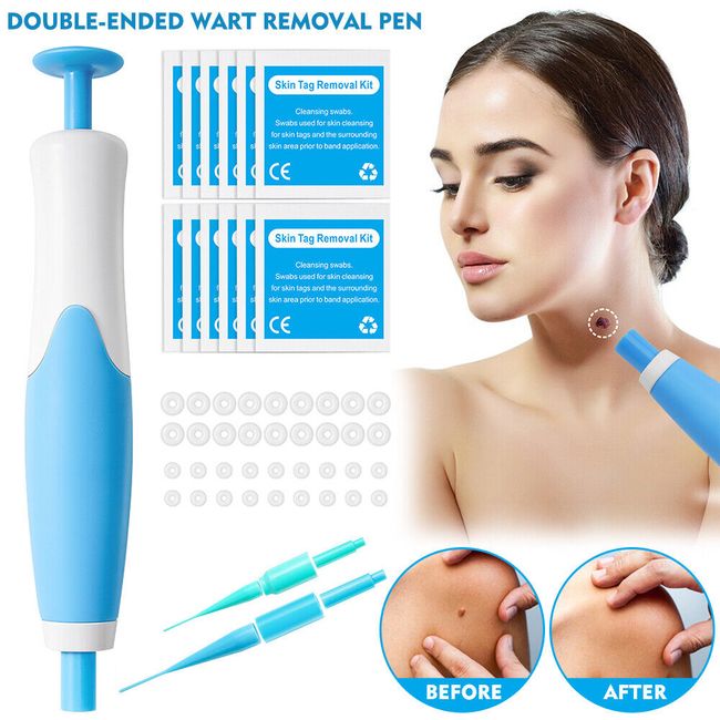 Painless Skin Tags & Moles Warts Corn Remover(40x Rubber Bands +10x Alcohol Pad)