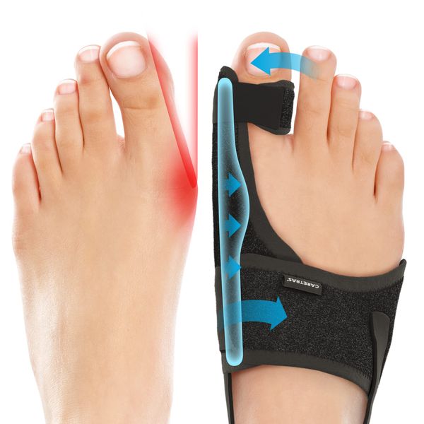 Caretras Bunion Corrector for Women & Men 2pc - Bunion Splint & Big Toe Straightener for Hallux Valgus - Bunions Correction Women & Men - Bunion Pads for Bunion Relief - Day & Overnight Support Brace