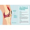 Artritis Reumatoide|Ali
