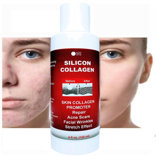 Skin Scars Silicon and Collagen Hydrolyzed Gel Resurfacing Skin Collagen Promoter For Indented Atrophic Rolling Face Scars By ALKA VITA