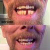 INSTANT SMILE SELECT A TOOTH REPLACEMENT KIT temporary missing tooth fix BRIGHT