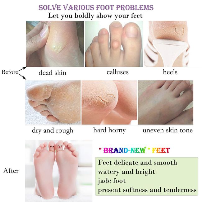 How to Remove Dead Skin from Feet