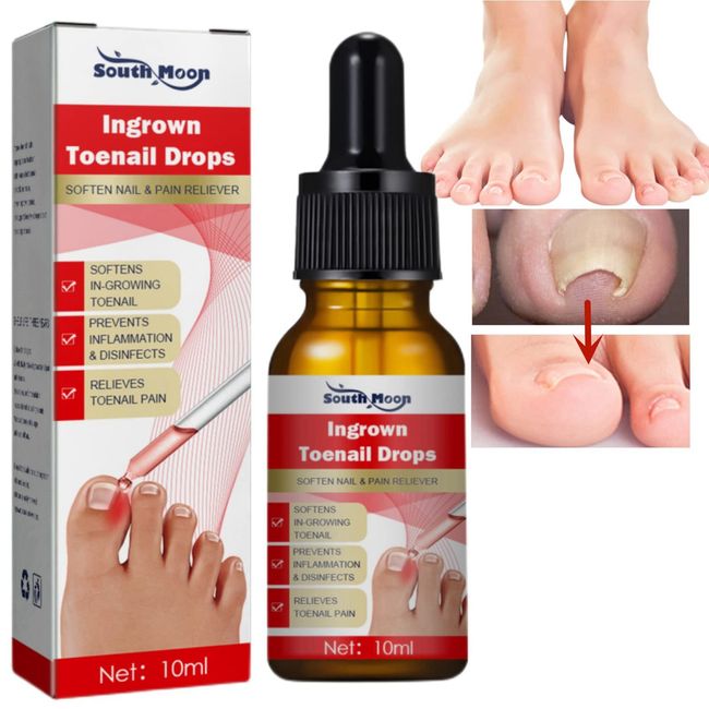 Ingrown Toenail Treatment,Nail Helper,Nail Growth Treatment,Ingrowing Toenail Treatment,Ingrown Toenail Correction Drops,Ingrown Toenail Corrector,Treatment for Ingrown Toenail,Cuticle Oil