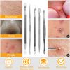 Blemish Blackhead Remover 5 Piece Set Extractor Tools Pimple Removal Kit White