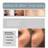 Derma Roller 1.5mm SILVER Needles, ONLY for Professional Users, 540 Microneedle roller for Beard and Hair Growth, Anti-Aging Stretch Marks Scars