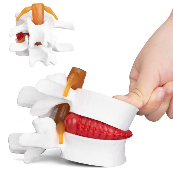 ANNWAN Disc Herniation Model - Human Lumbar Disc Herniation Spine Model Vertebrae Disc Model for Teaching and Studying