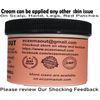 Scalp psoriasis cream treatment reduce redness intense itching
