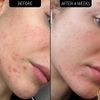 The INKEY List SuperSolutions Blemish Clearing Moisturizer 2% NovoRetin