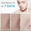 Dark Spot Remover For Face, Hyperpigmentation Treatment, Dark Spot Serum, Melasma treatment for face, Blemish spot treatment, Freckle Remover for Sun Spots, Acne Scars, Melasma for Men & Women, 30g