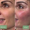 Skin Booster Hyaluronic Acid Authentic