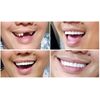 Billy Bob Instant Smile Comfort Fit Flex Cosmetic Teeth, Bright White Shade, Comfortable Upper Veneer, 1 Size Fits Most