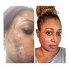 Acne Face Kit 4pc. Acne,Spots,Large Pores, Hyperpigmentation, Sunburn & Melasma