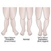 LAMINET Posture Corrective Heel Cups - Large - Fits Women's Shoe Size 8.5-11 / Fits Men's Shoe Size 7-13