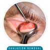 Mehoefer Chalazion Curettes Eye Ear Wax Remover (Size 0)