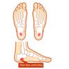 Pedag 201 Point Plus Heel Spur Cushion, Extra-Large (US M11-13/EU 44-46)