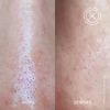 ZITPROOF® NOSE - Hydrocolloid patches for nose