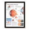 Understanding Glaucoma Framed Medical Educational Poster, 22x28 Wall Diagram