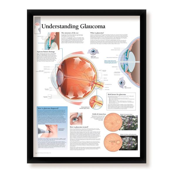 Understanding Glaucoma Framed Medical Educational Poster, 22x28 Wall Diagram