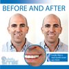 Instant Smile Pro Series Temporary Tooth Kit - With extra pack of fitting beads