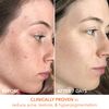 Dr. Dennis Gross Alpha Beta Universal Daily Peel: for Uneven Tone or Texture and Fine Lines or Enlarged Pores, (30 Treatments)