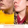 Dr. Dennis Gross Alpha Beta Universal Daily Peel: for Uneven Tone or Texture and Fine Lines or Enlarged Pores, (30 Treatments)