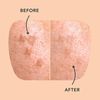 Rael Pimple Patches, Miracle Microcrystal Spot Cover - Dark Spot Corrector, Hydrocolloid, Post Acne, with Skin Brightening, for All Skin Types, Vegan, Cruelty Free (6 Count)