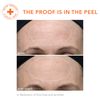 Dr. Dennis Gross Alpha Beta Ultra Gentle Daily Peel: for Dehydrated or Sensitive Skin, Uneven Tone or Texture, Fine Lines or Enlarged Pores (5 Treatments)
